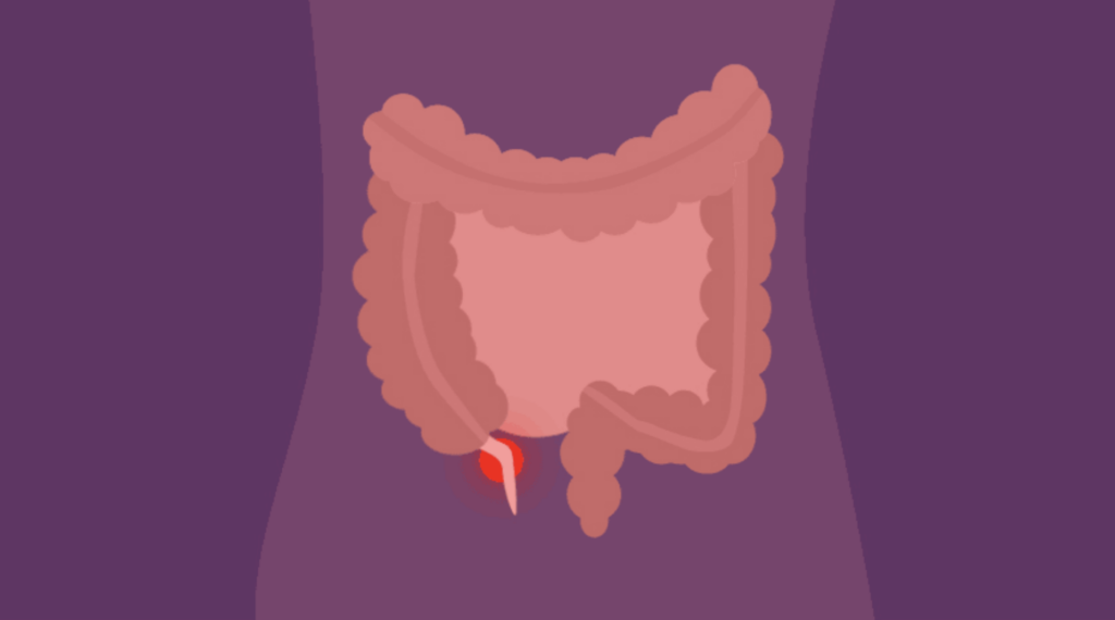 appendicitis lawyer